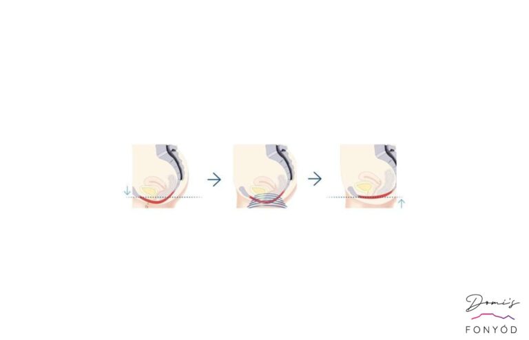 HIEMT intimpad - Blog